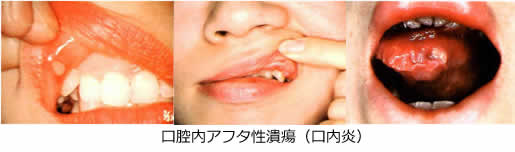 口腔内アフタ性潰瘍（口内炎）の写真3枚