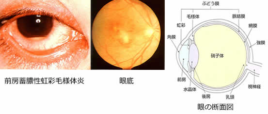 左から前房蓄膿性虹彩毛様体炎・眼底の写真・眼の断面図
