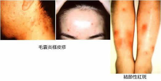 皮膚症状の写真3枚（左から毛嚢炎様皮疹2枚・結節性紅斑）